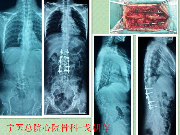 脊柱畸形—胸腰椎陈旧骨折并退变,侧后凸畸形矫正