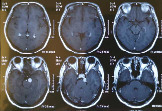 贺晓生教授颅腔深部肿瘤手术天幕缘脑膜瘤切除案例