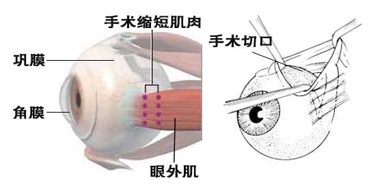 斜视手术切口在眼白处,最小仅3-4毫米_好大夫