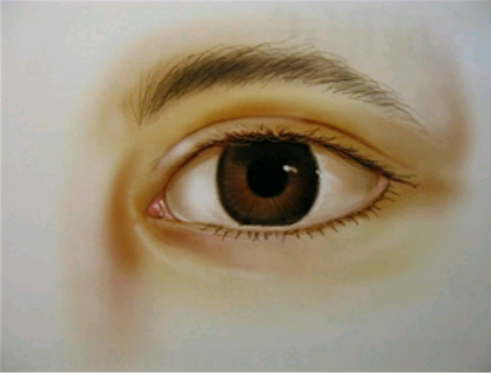 为什么要做开眼角手术(内眦开大)手术? - 好大夫