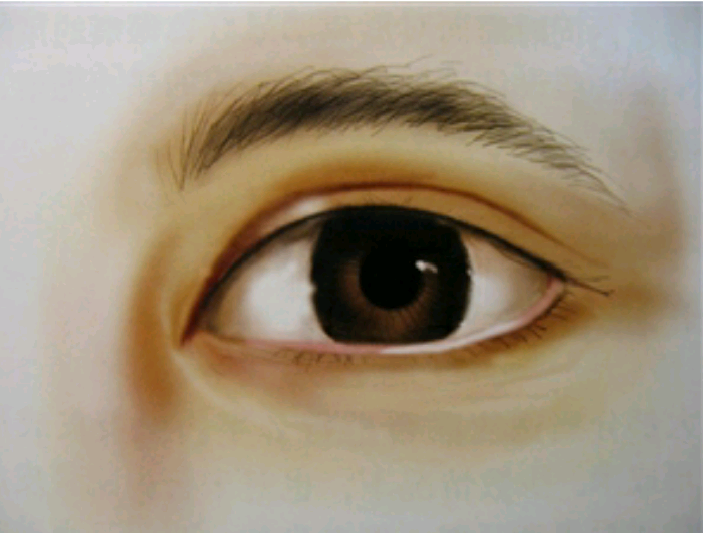 为什么要做开眼角手术(内眦开大)手术? - 好大夫