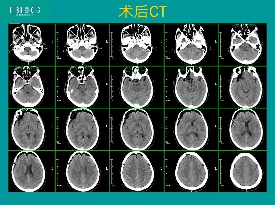 鞍区囊实性占位,考虑颅咽管瘤.62 头颅ct和mri:家人听到手术风