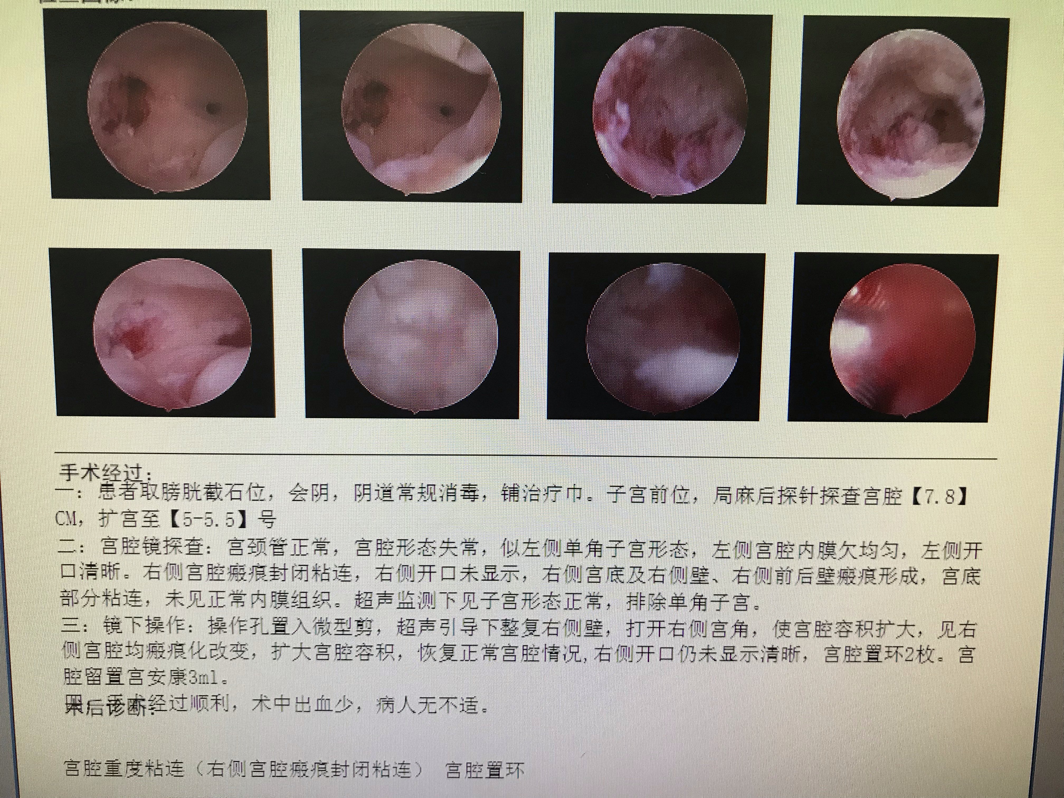 病例--单角子宫形态的宫腔粘连.