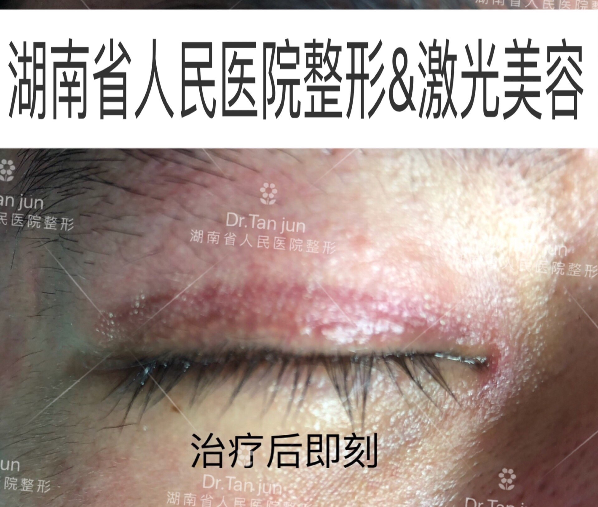 眼皮子上做激光治疗会不会伤到眼睛?