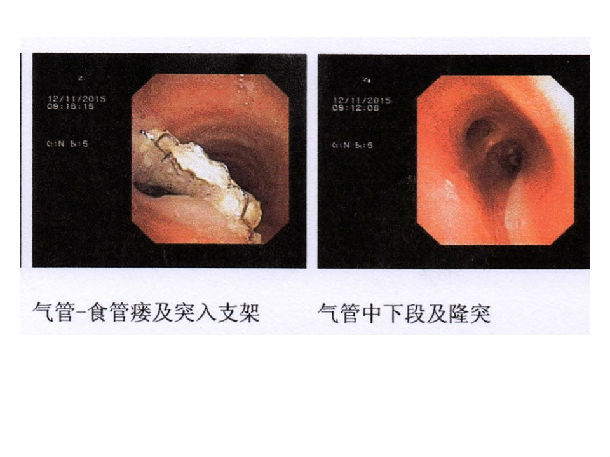 男性,25岁,因吞咽困难于2013-12胃镜检查提示:食管狭窄(距门齿22cm