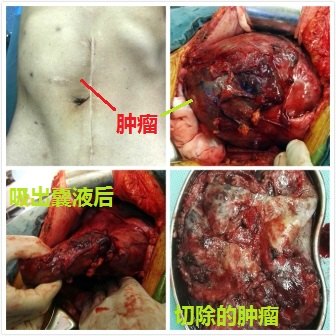 小肠间质瘤术后肝巨型转移肿瘤减瘤术