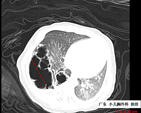 无症状的先天性肺囊腺瘤手术or保守