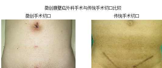 微创腹腔镜疝修补手术疤痕图片 - 好大夫在线