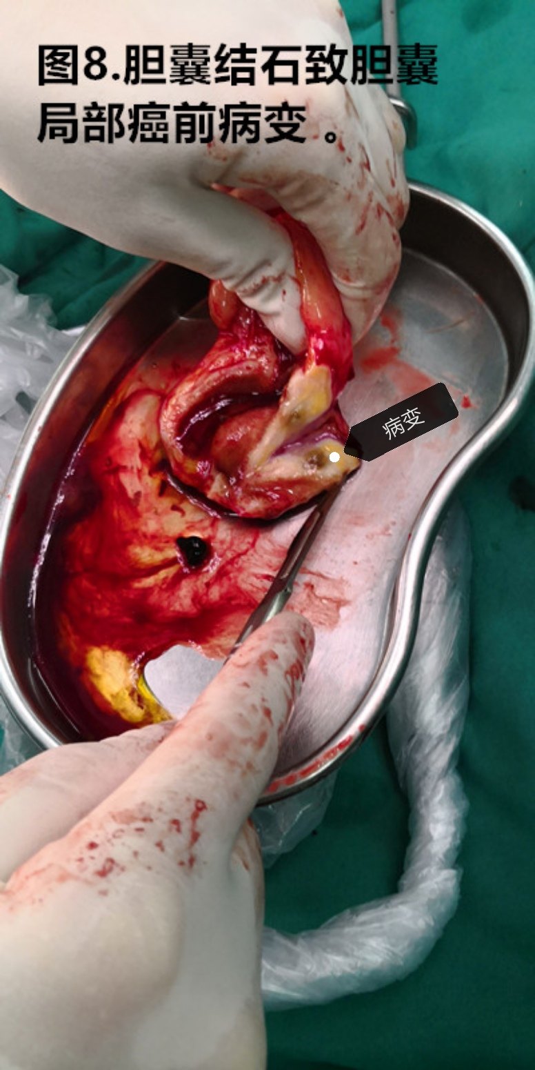 图片展示长期胆囊结石可能会导致的部分结果