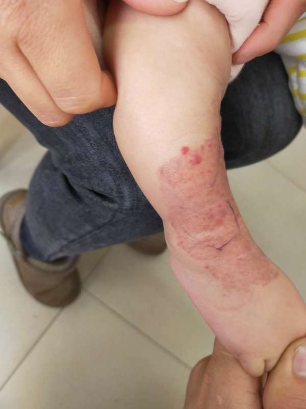 大面积血管瘤治疗后复查一个疗程