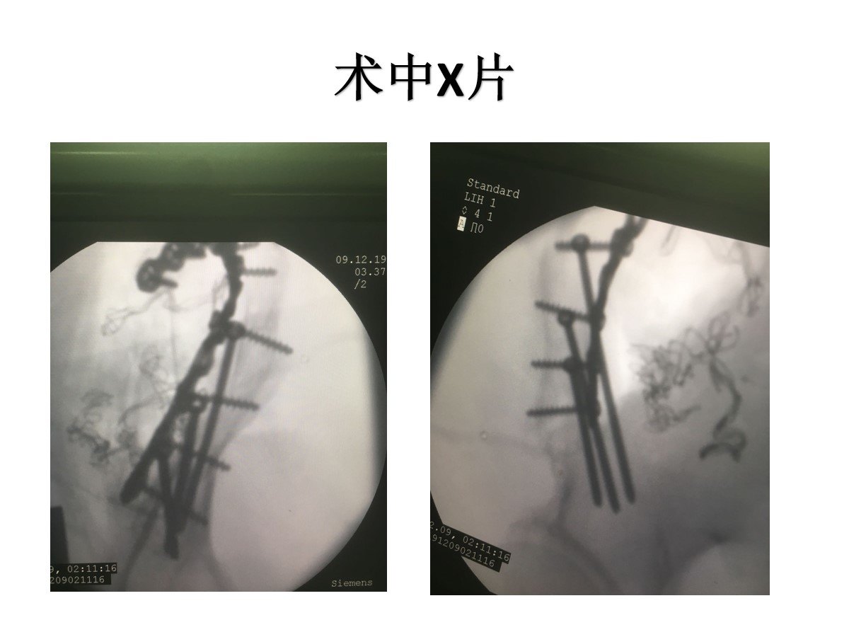 髂腹股沟入路治疗骨盆骨折