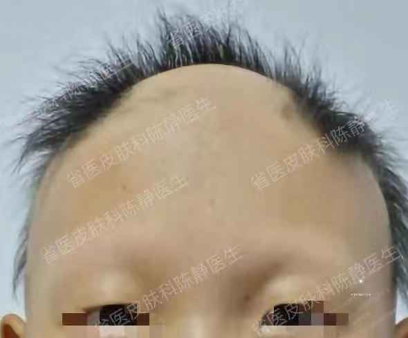 普秃,头发全部脱落,眉毛,睫毛,体毛全部脱落