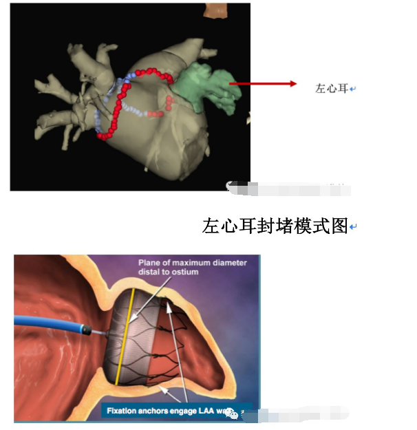 预防房颤患者发生脑梗塞(中风):左心耳封堵术(绵阳市中心医院患者教育