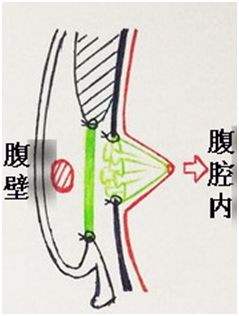 腹股沟疝全知道8腹股沟疝修补术