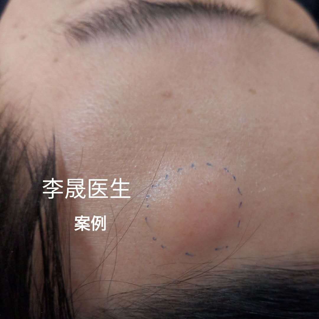额部脂肪瘤微创无痕切除