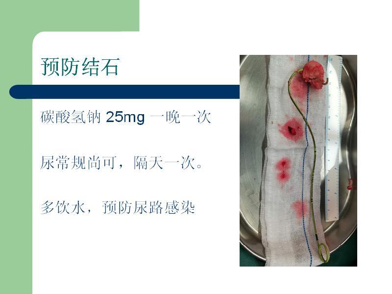 肾积水术后留置输尿管支架管注意事项