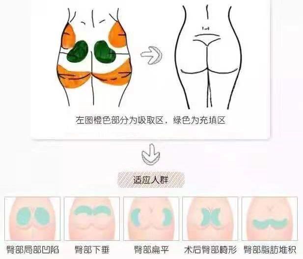 自体脂肪丰臀—让你的脂肪"臀臀欲动"