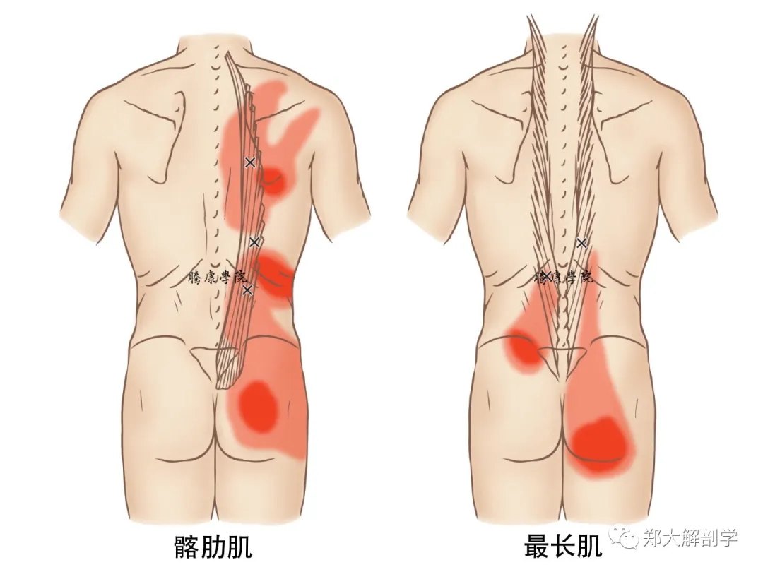 竖脊肌损伤背痛及活动受限