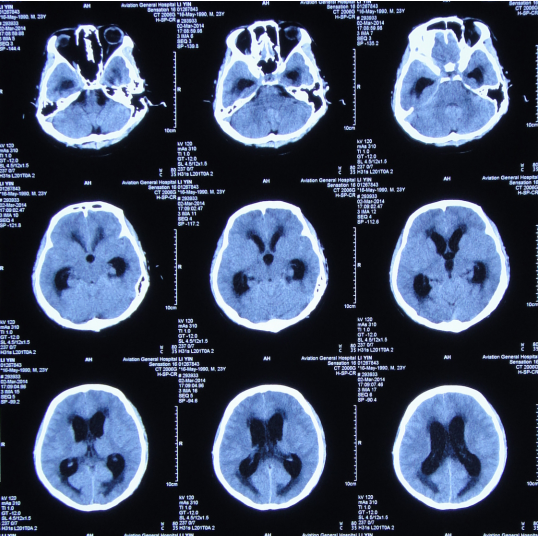 2014-3-2头ct:脑室系统扩张,脑室旁间质性脑水肿,脑皮层水肿明显[图