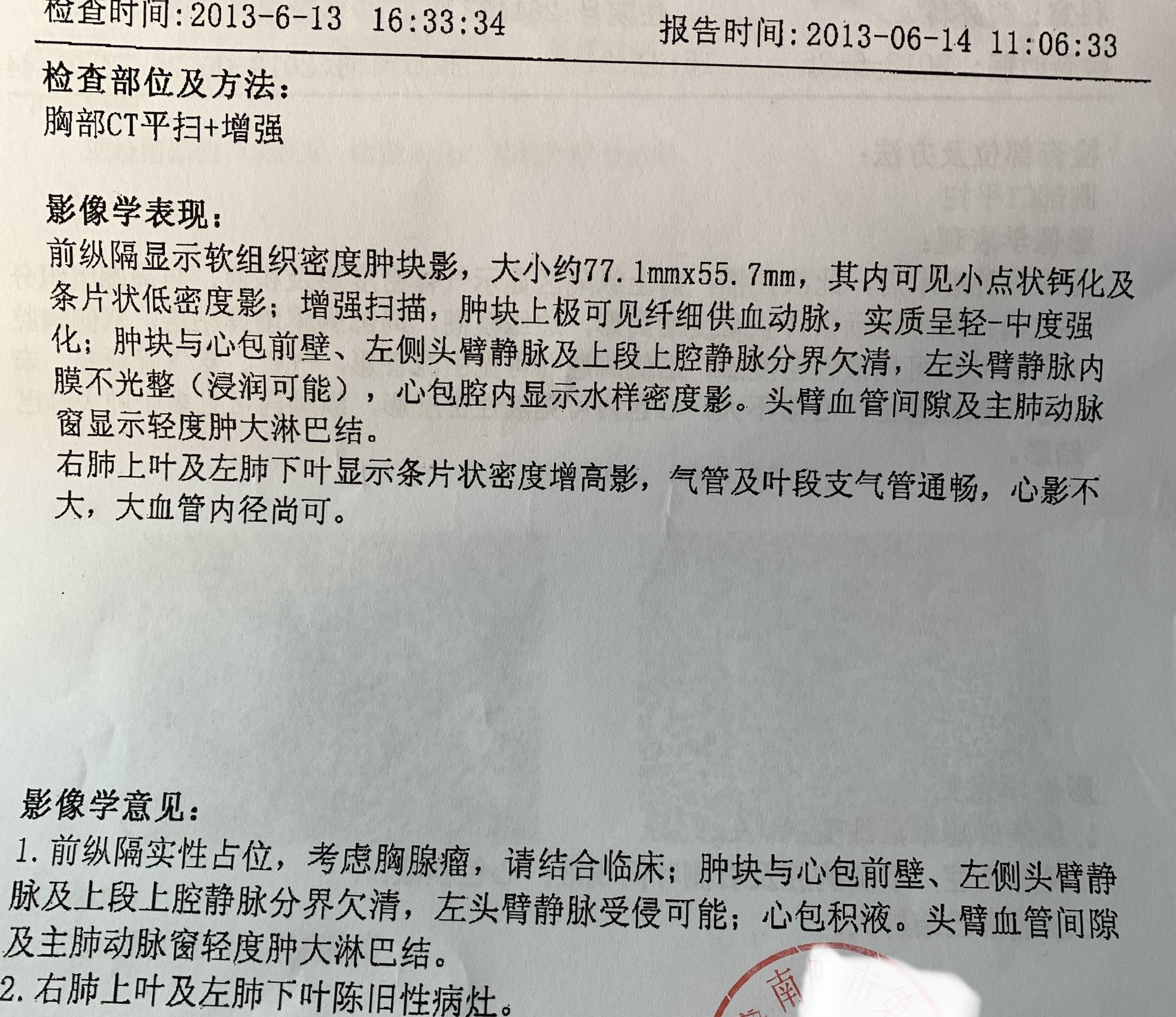 b1型胸腺瘤手术切除后6年发生复发转移