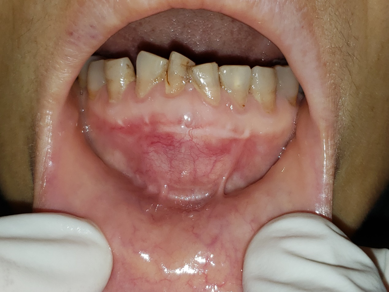 两者较容易被混淆,但成人龈囊肿一般发生在牙龈软组织上,不侵犯骨组织