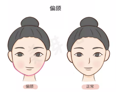 大小脸偏颌畸形的基本特征有哪些
