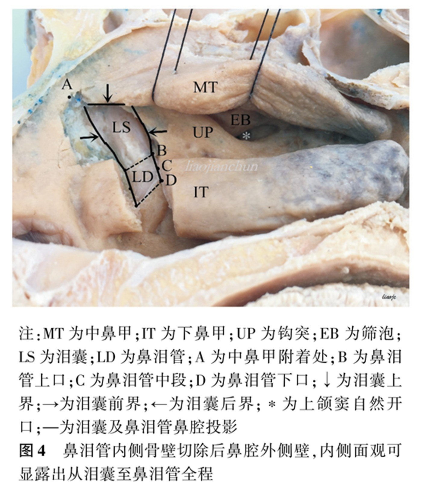 而且大部分位于下鼻甲附着处前1/3段,男性鼻泪管多开口于下鼻道侧壁