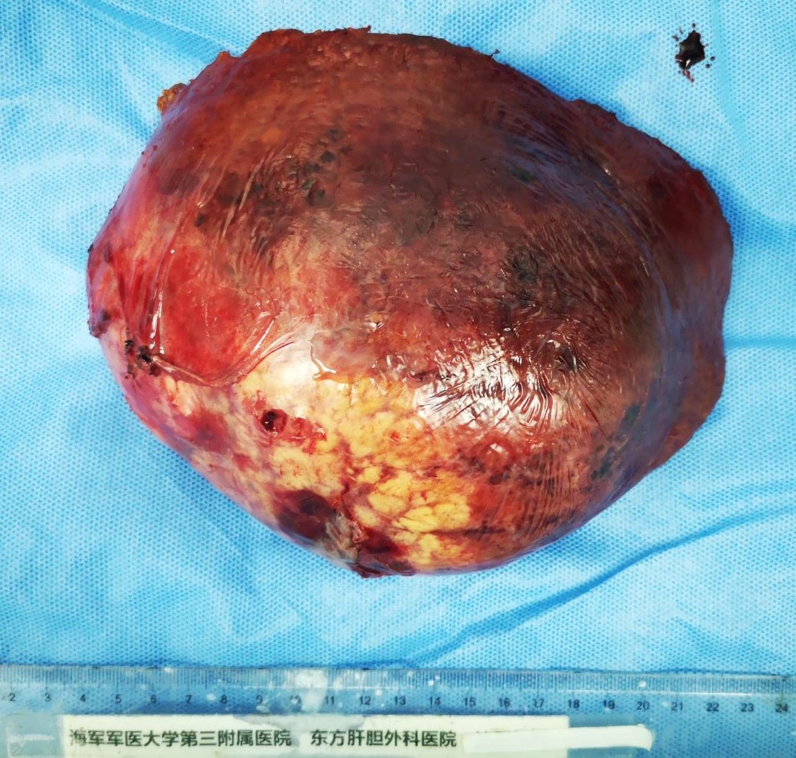 巨块型肝癌的手术切除