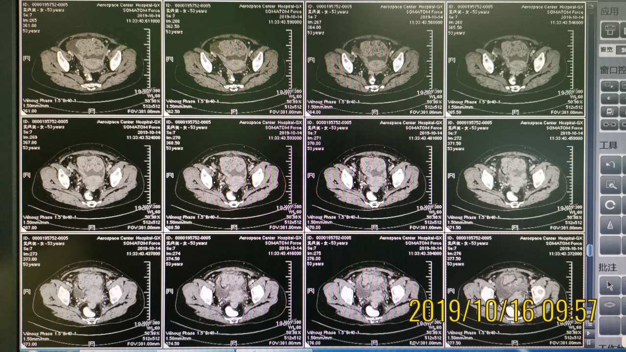 68u/ml.入院ct如下:1 病史特点:2019.2体检发血ca125升高,2019.