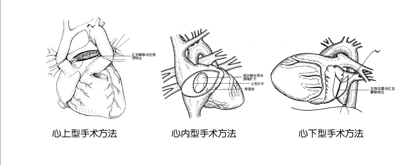 什么是完全性肺静脉异位引流