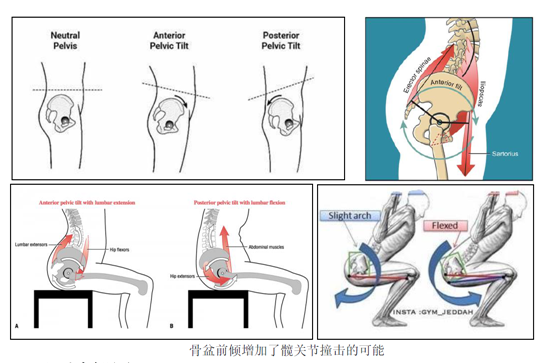 得了髋关节撞击症不手术怎么治保守康复方案