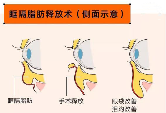 为什么说眶隔脂肪释放术的一举两得如何理解