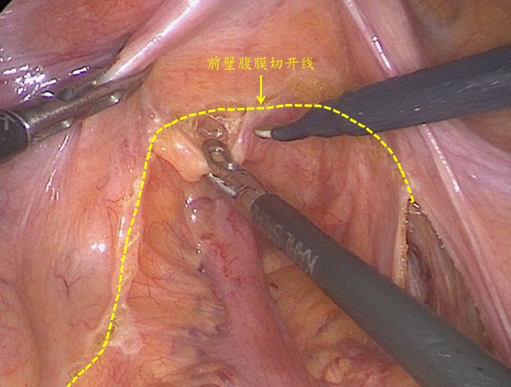 0cm处切开盆底腹膜,并在denonvilliers 筋膜和精囊腺之间游离直肠前壁