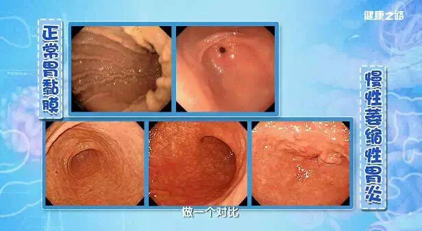 > 慢性萎缩性胃炎→胃癌