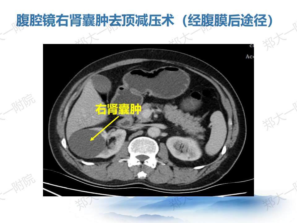 肾囊肿的诊断和治疗经验