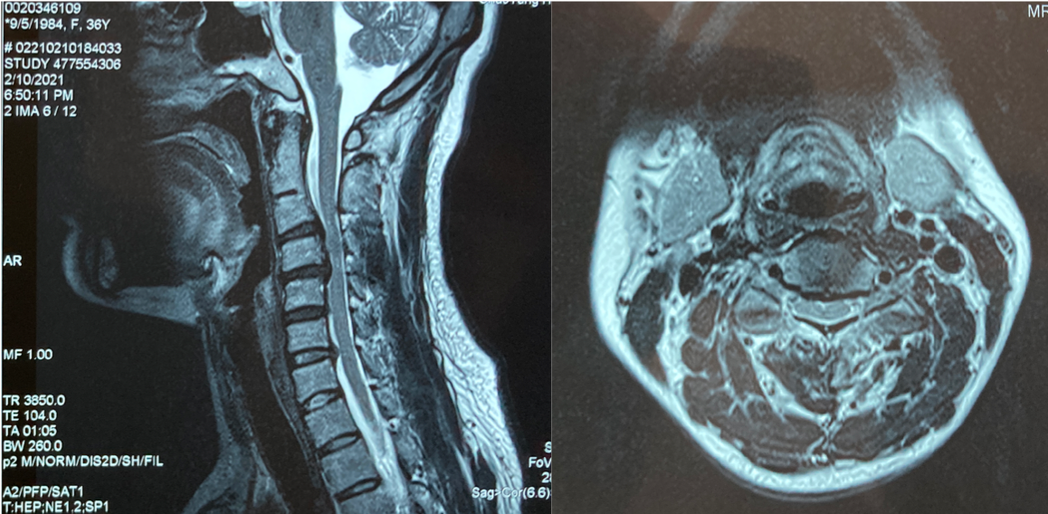 这是典型的脊髓性颈椎病的临床表现,所以进一步了解颈椎核磁检查结果