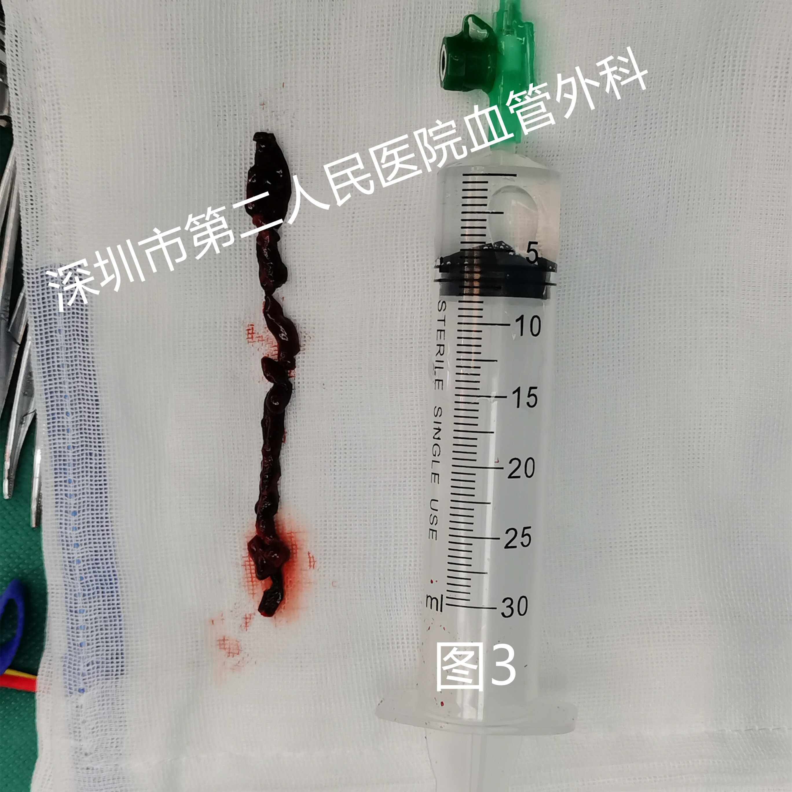 手术过程顺利,术后患者下肢血液复通,皮肤颜色正常,皮温由凉变暖,足背