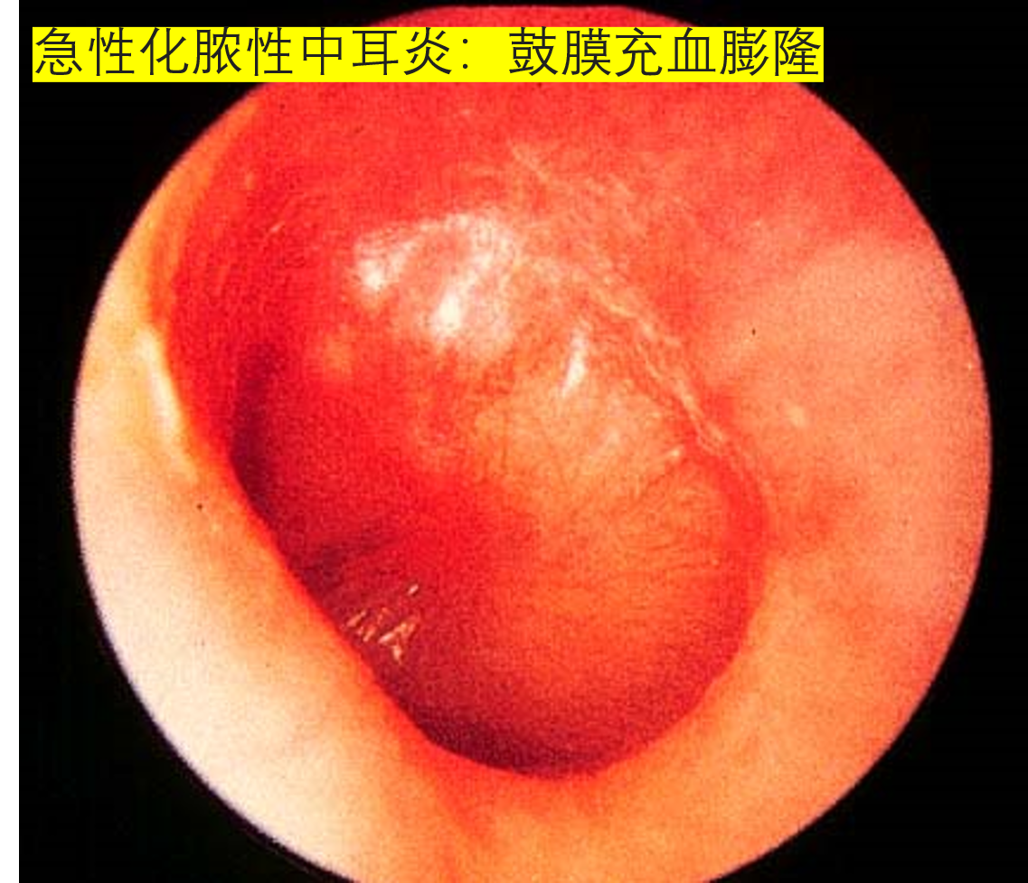 2, 大疱性鼓膜炎 :鼓膜充血,表面有血疱.