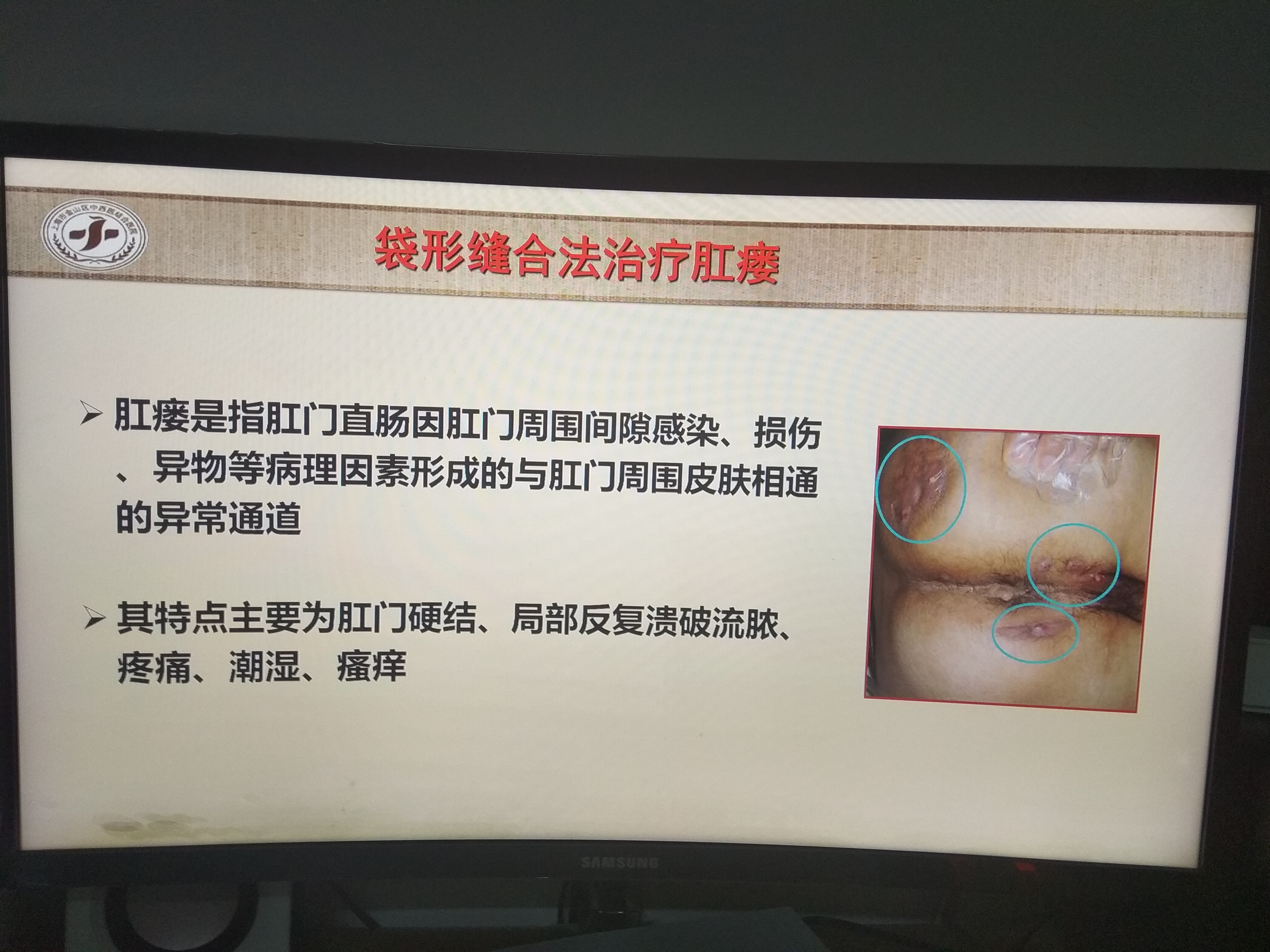 枫泾医院肛肠科特色手术方法介绍袋形缝合法治疗肛瘘