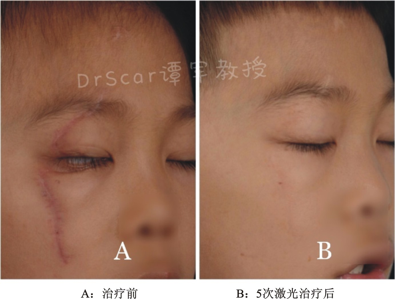 好大夫在线 谭军 > 增生性瘢痕的激光-皮肤再生修复(二) case20:面部