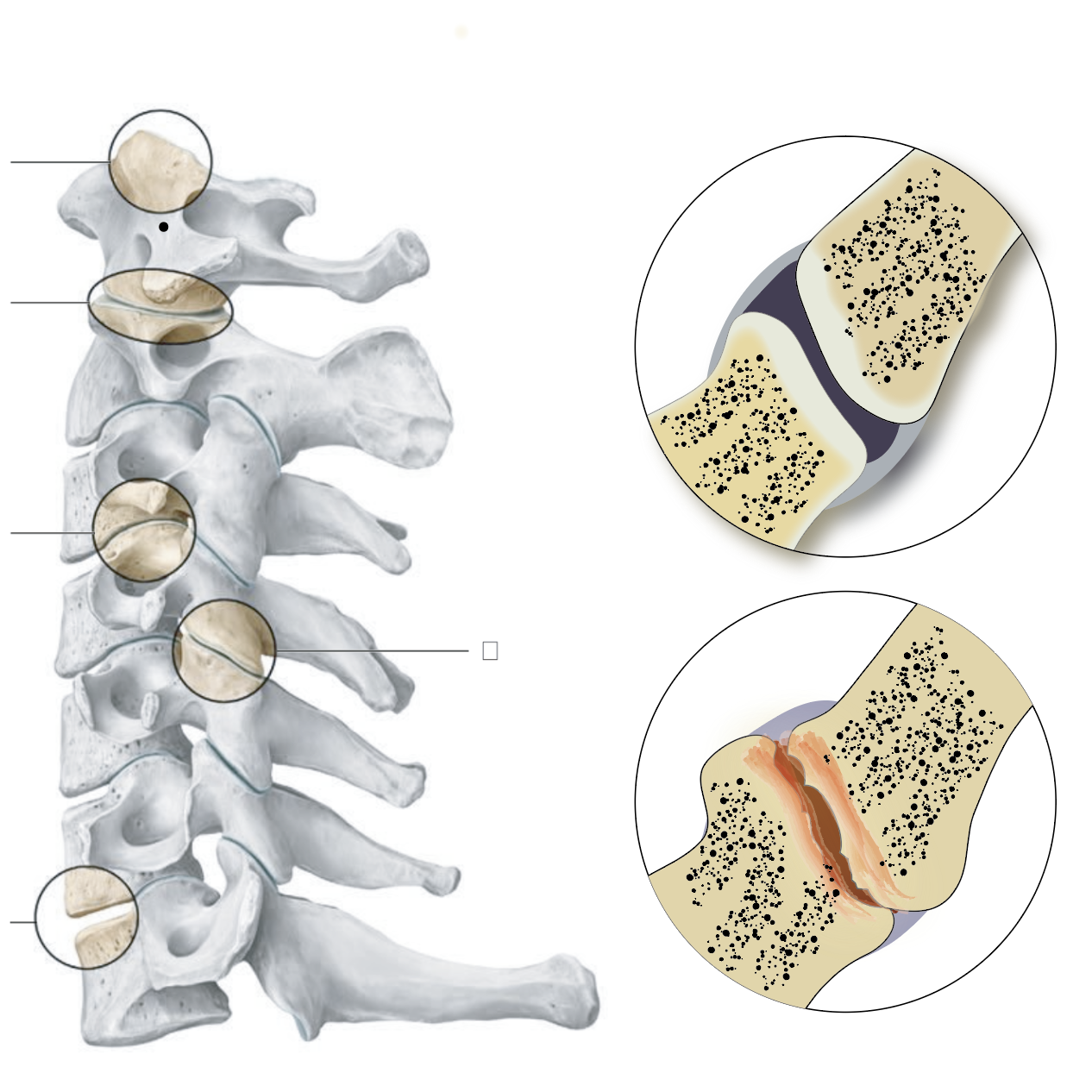 "脖子痛" "脖子响"的重要原因:颈椎小关节紊乱