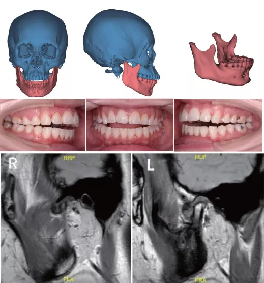 图4 患者女,22 岁,双侧进展性髁突吸收,锥形束ct(cbct)重建显示双侧