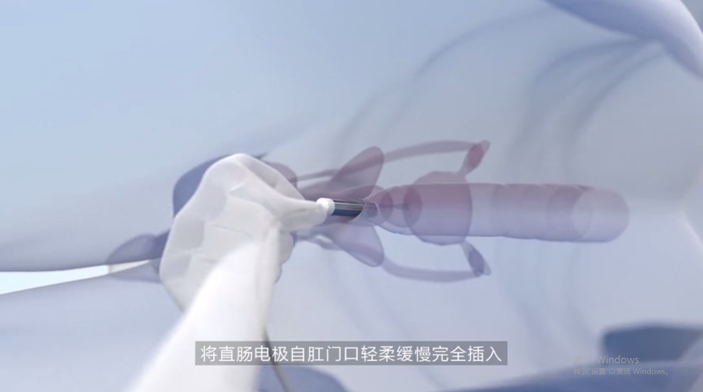 应用智能聚焦场能经直肠直接作用于病灶,应用直肠灌注药物巩固疗效