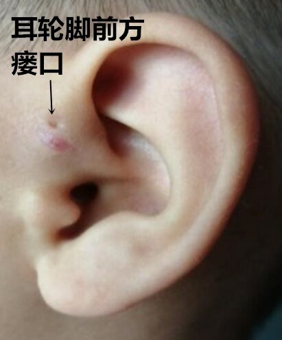 变异型耳前瘘管