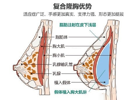 脂肪丰胸假体隆胸复合隆胸你适合哪种自己在家也能测