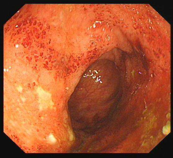 炎症常先累计直肠和乙状结肠,并且以连续和环周的形式向近端结肠蔓延.
