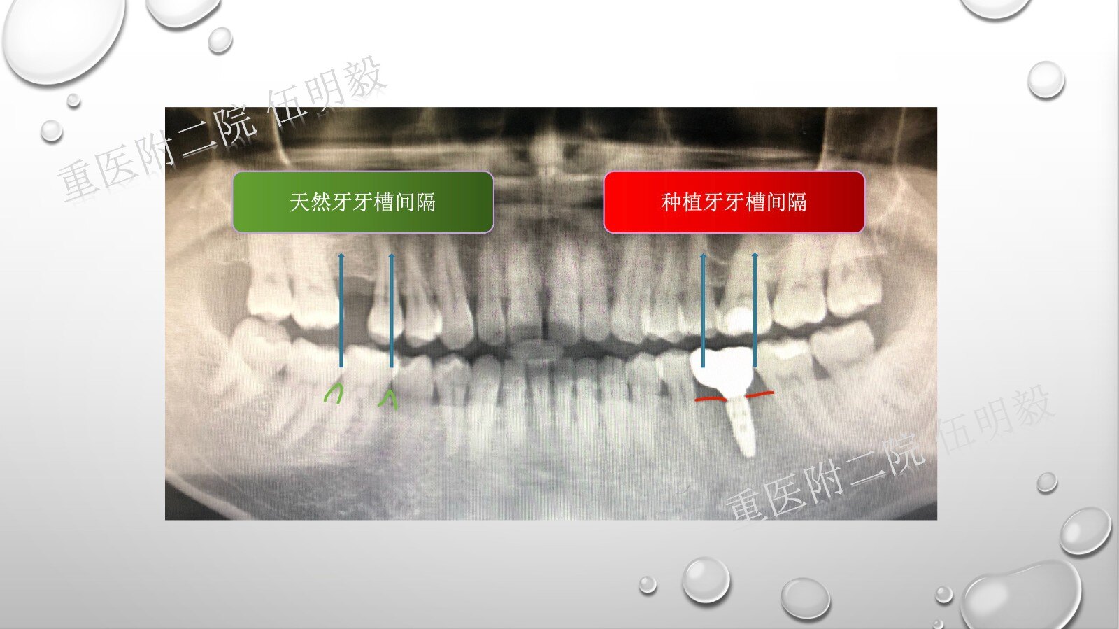 牙之间有一个明显的区别,也就是在天然牙与天然牙之间,会有牙槽间隔