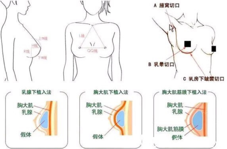 假体隆胸选择什么切口位置比较好?