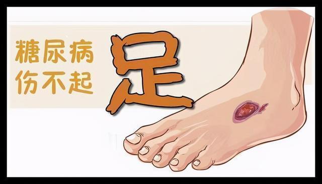 血管和神经病变,糖尿病血管和神经病变互相影响而引起一系列临床脚病