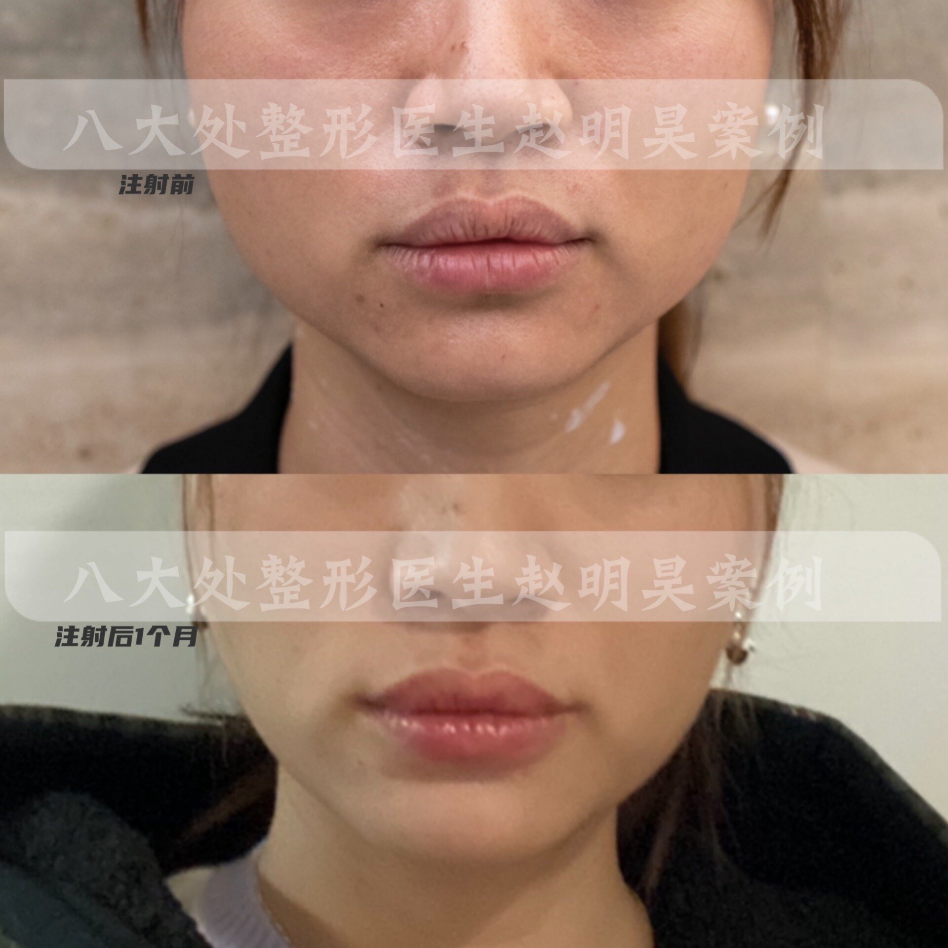 咬肌肥大怎么办